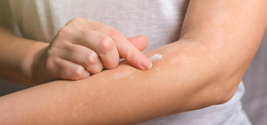 Schuppenflechte: Symptome, Ursachen und Pflegetipps