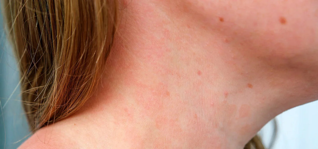 Neurodermitis: Ursachen, Symptome & Pflege