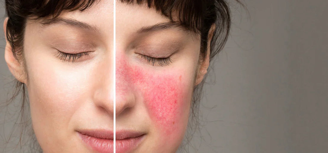 Rosacea - Ursachen, Behandlung und Pflegetipps